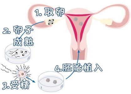 凍結胚移植